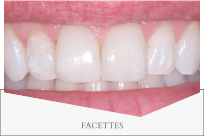 FACETTES