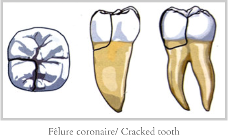 Fêlure coronaire/ Cracked tooth