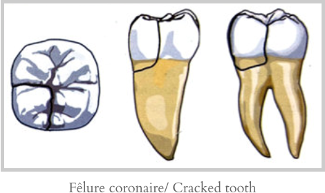 Fêlure coronaire/ Cracked tooth