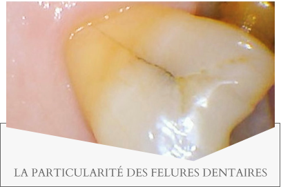 LA PARTICULARITÉ DES FELURES DENTAIRES
