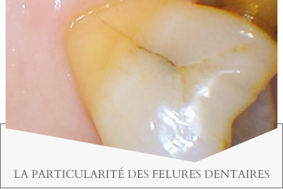 LA PARTICULARITÉ DES FELURES DENTAIRES