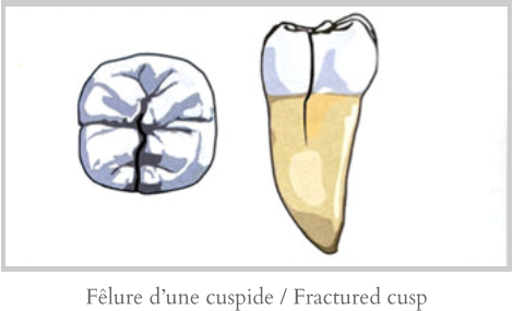 Fêlure d’une cuspide / Fractured cusp